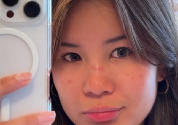 女生看演出鼻梁被砸骨折